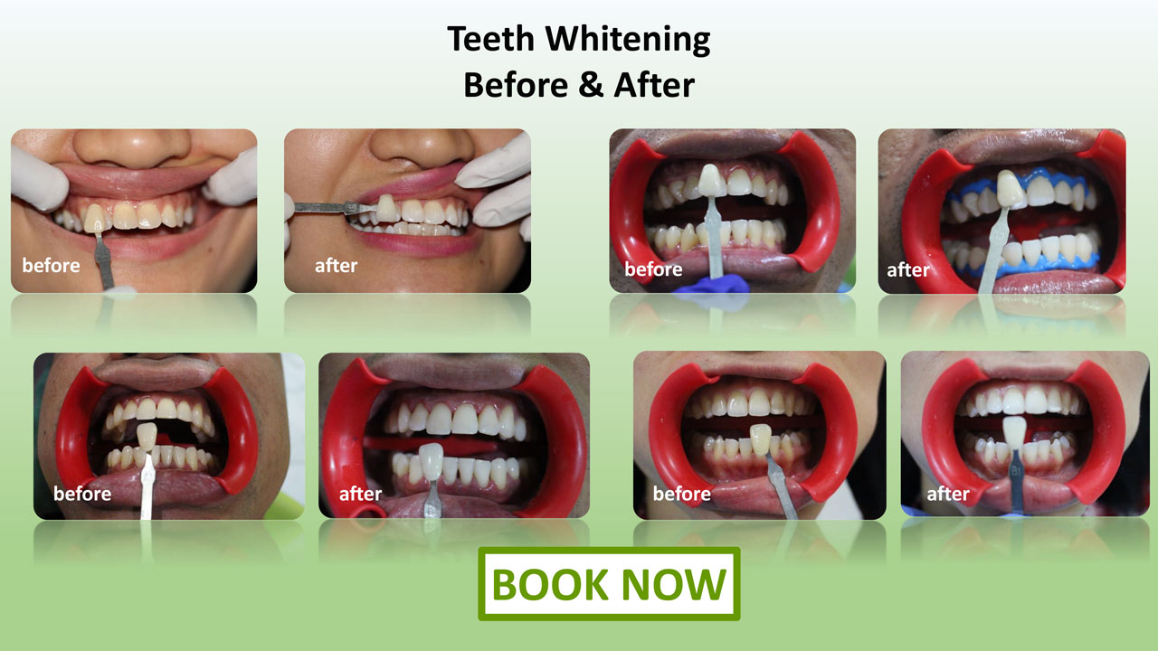 Teeth Withening Before & After